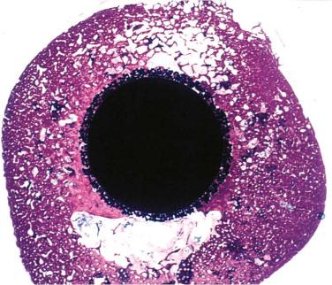 Fig. 66.1, Histologic slide showing cross-section of a femoral porous-coated total hip prosthesis with bone ingrowth into the beaded implant surface.