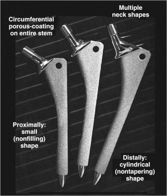 Fig. 66.2, The shape of the typical extensively porous-coated stem is a cylinder distally for fixation in the femoral diaphysis and a triangle proximally to fit the patient's femoral metaphysis. Pictured here are extensively porous-coated anatomic medullary locking femoral components.