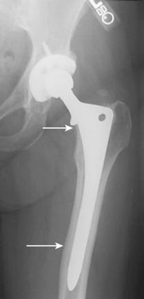 Fig. 69.2, The consistent concern associated with extensively porous coated, cylindrical stems has been stress shielding. Arrows show poor bone remodeling in a well-fixed, extensively porous coated femoral stem.