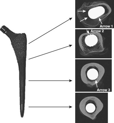 Fig. 69.3, Computed tomography images from four regions along the length of a tapered cementless femoral implant (Synergy, Smith & Nephew, London, UK). Proximally, primary cancellous contact occurs. In the proximal quarter, there is posterior cortical contact ( arrow 1 ). In the second quarter, there is anterior cortical contact ( arrow 2 ). In the third quarter, there is cortical contact posteriorly ( arrow 3 ).