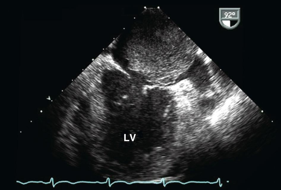 Fig. 18.1, Transesophageal echocardiographic characteristics of a large left atrial myxoma. Midesophageal two-chamber view during systole shows a 5 × 7 cm mass located in the left atrium. LV, Left ventricle.