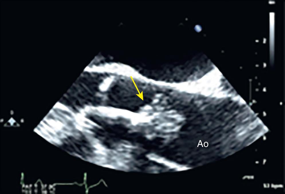 Fig. 18.2, Giant aortic valve papillary fibroelastoma. Transesophageal midesophageal long-axis view of the aortic valve shows the 4.7-cm pedunculated mass attached to the right coronary cusp of the aortic valve (yellow arrow) . LV , Left ventricle; Ao , aortic opening.