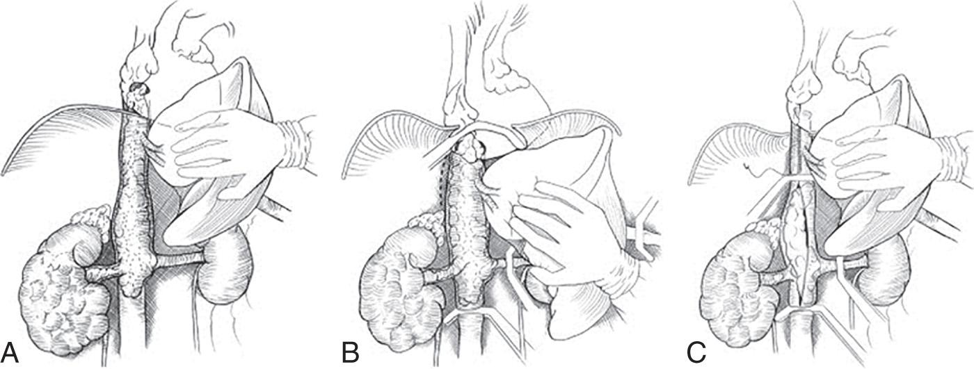 Fig. 18.3, Surgical technique for level IV tumor extraction, avoiding cardiopulmonary bypass. (A) Mobilization of the liver off the retrohepatic inferior vena cava (IVC). (B) Dissection of the IVC and central tendon of the diaphragm off the posterior abdominal wall (dashed lines) and clamping of the distal IVC, the right atrium, the left renal vein, and the porta hepatis. (C) Milking the tumor from the supradiaphragmatic IVC, enabling it to be extracted without a sternotomy or the need for cardiopulmonary bypass.