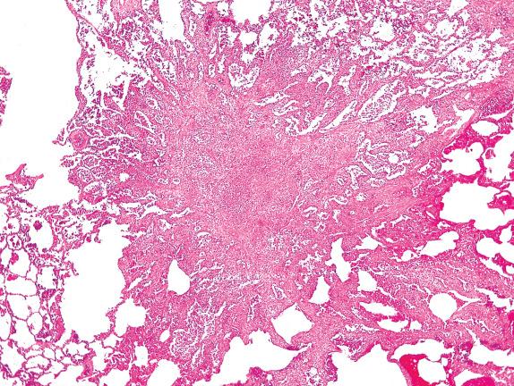 FIG. 23.1, Pulmonary Langerhans cell histiocytosis. This stellate inflammatory and fibrotic nodule is associated with air space enlargement at its periphery.