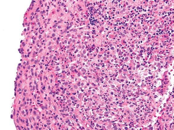 FIG. 23.2, Pulmonary Langerhans cell histiocytosis. Numerous Langerhans cells display folded or indented nuclei and occasional nuclear grooves. Eosinophils, lymphocytes, and neutrophils accompany the Langerhans cells.