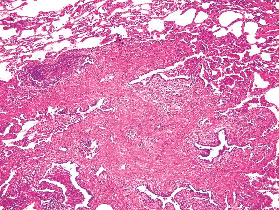 FIG. 23.3, Pulmonary Langerhans cell histiocytosis. This older nodule has a fibrotic appearance. Pigmented smokers’ macrophages fill airspaces adjacent to the edges of the nodule.