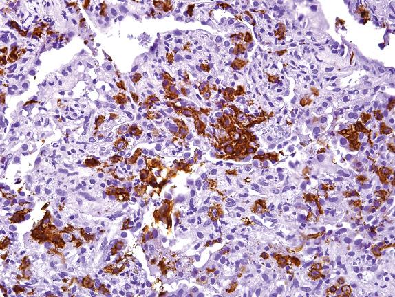 FIG. 23.5, Pulmonary Langerhans cell histiocytosis. This immunohistochemical stain for CD1a highlights numerous Langerhans cells, singly and in clusters.