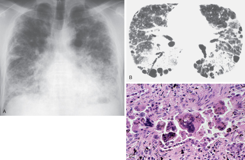 Fig. 63.1, Hard metal interstitial lung disease. (A) Posteroanterior chest radiograph reveals coarse reticular pattern and patchy ground-glass opacities involving predominantly the peripheral lung regions and lower lung zones. (B) High-resolution CT scan shows extensive bilateral ground-glass opacities, foci of consolidation, centrilobular nodules, mild reticulation, traction bronchiectasis, and several bullae. (C) Histologic specimen of the lung obtained at autopsy shows bizarre multinucleated giant cells along with interstitial inflammation and fibrosis in the alveolar airspaces.