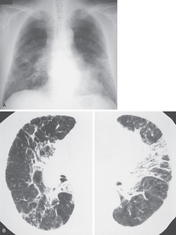 Fig. 63.2, Hard metal interstitial lung disease. (A) Chest radiograph shows reticulonodular pattern in the middle and lower lung zones. (B) High-resolution CT scan shows ground-glass opacities, areas of consolidation, mild reticulation, and traction bronchiectasis.