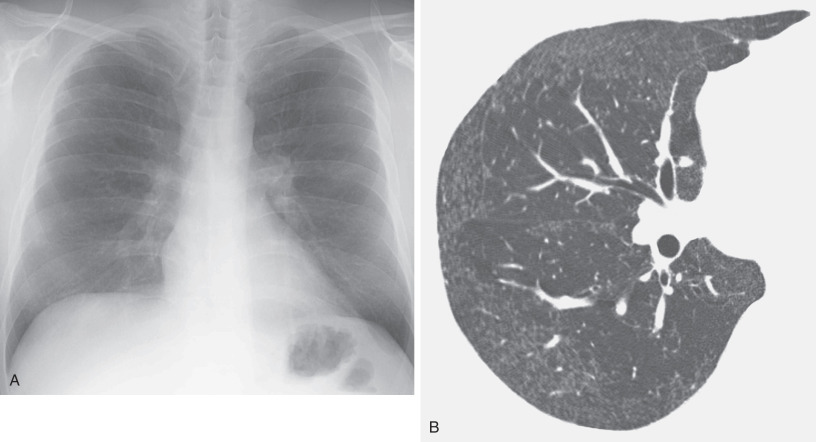 Fig. 63.3, Hard metal interstitial lung disease. (A) Chest radiograph shows hazy opacity and fine nodular pattern in the middle and lower lung zones. (B) View of the right lung from a high-resolution CT scan reveals fine nodular opacities in the peripheral lung regions.