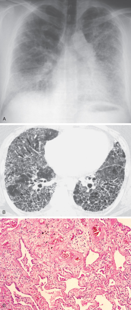 Fig. 63.4, Aluminum pneumoconiosis. (A) Chest radiograph shows extensive bilateral reticulonodular pattern. (B) High-resolution CT scan reveals extensive reticulation, traction bronchiectasis, traction bronchiolectasis, and honeycombing. (C) Histologic specimen of the lung obtained at surgical lung biopsy shows interstitial fibrosis with an interstitial mononuclear infiltrate.