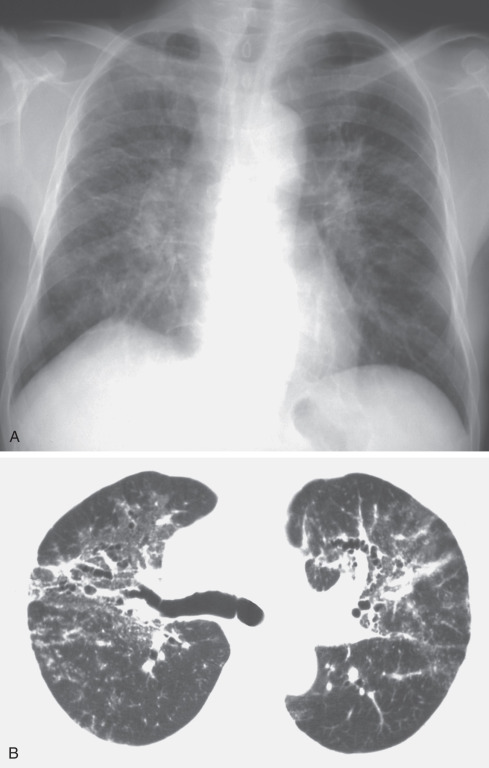 Fig. 63.5, Aluminum pneumoconiosis. (A) Chest radiograph shows ground-glass opacities mainly in the upper and middle lung zones. Mild upward displacement of the hila is also noted. (B) High-resolution CT scan shows ground-glass opacities mainly in the central lung regions, a few small nodular and irregular linear opacities, and traction bronchiectasis.