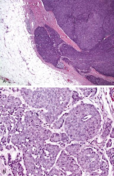 Fig. 52.1, Lymphocyte-rich thymoma with dense lymphocytic cell population containing scattered larger epithelial cells with pale cytoplasm surrounding perivascular spaces. (A) Low power (×100). (B) High power (×400).