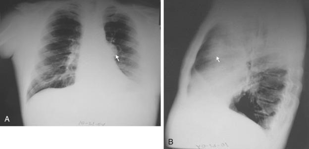 Fig. 52.2, (A) Anteroposterior chest radiograph demonstrates a mass (arrow) projecting over the left mediastinum and hilum. (B) Lateral chest radiograph confirms the location of the mass in the anterior mediastinum.