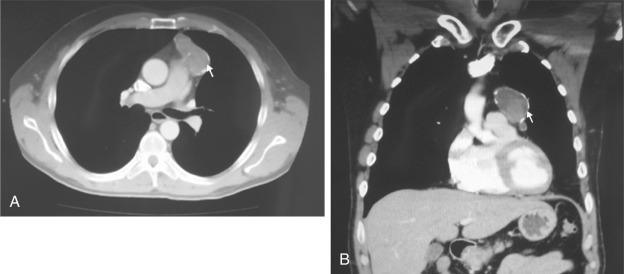 Fig. 52.3, Computed tomography (CT) demonstrates a mass (arrow) with calcification in the anterior mediastinum. (A) Axial view. (B) Coronal view.