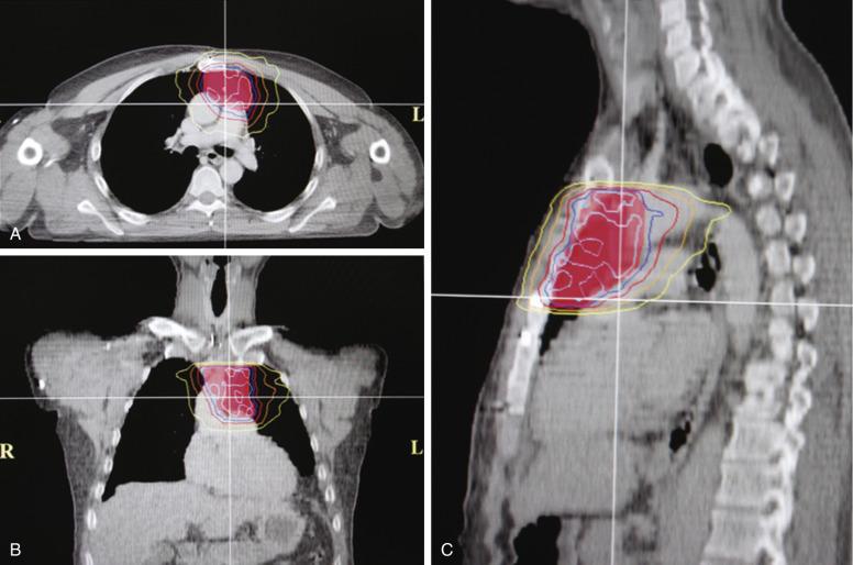 Fig. 52.5, Axial (A), coronal (B), and sagittal (C) views for intensity-modulated radiation therapy (IMRT). Isodose lines are closely conformal to the shape of the planning target volume (red) .