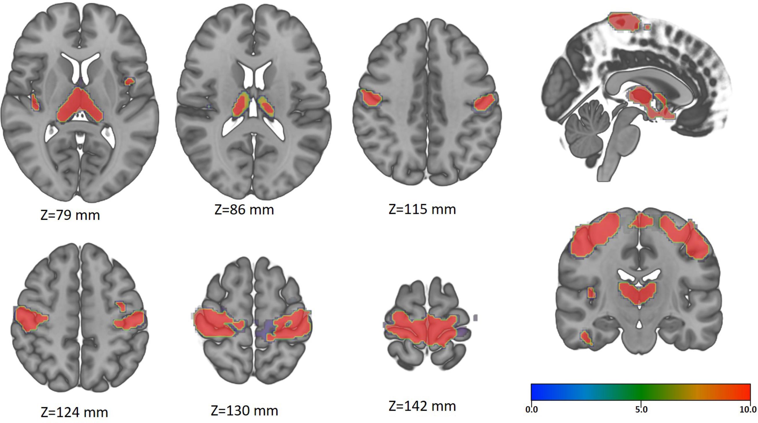Fig. 2, Representation of the regional areas with significant cortical volume reduction in a group of patients with prolonged cervical spine compression. The results were obtained from a voxel-based morphometry analysis in a group of 64 subjects (32 cervical spondylosis patients vs. 32 healthy controls, P < .05 corrected), suggesting that prolonged cervical spine compression led to thalami, sensorimotor cortex, and supplementary motor area atrophy.