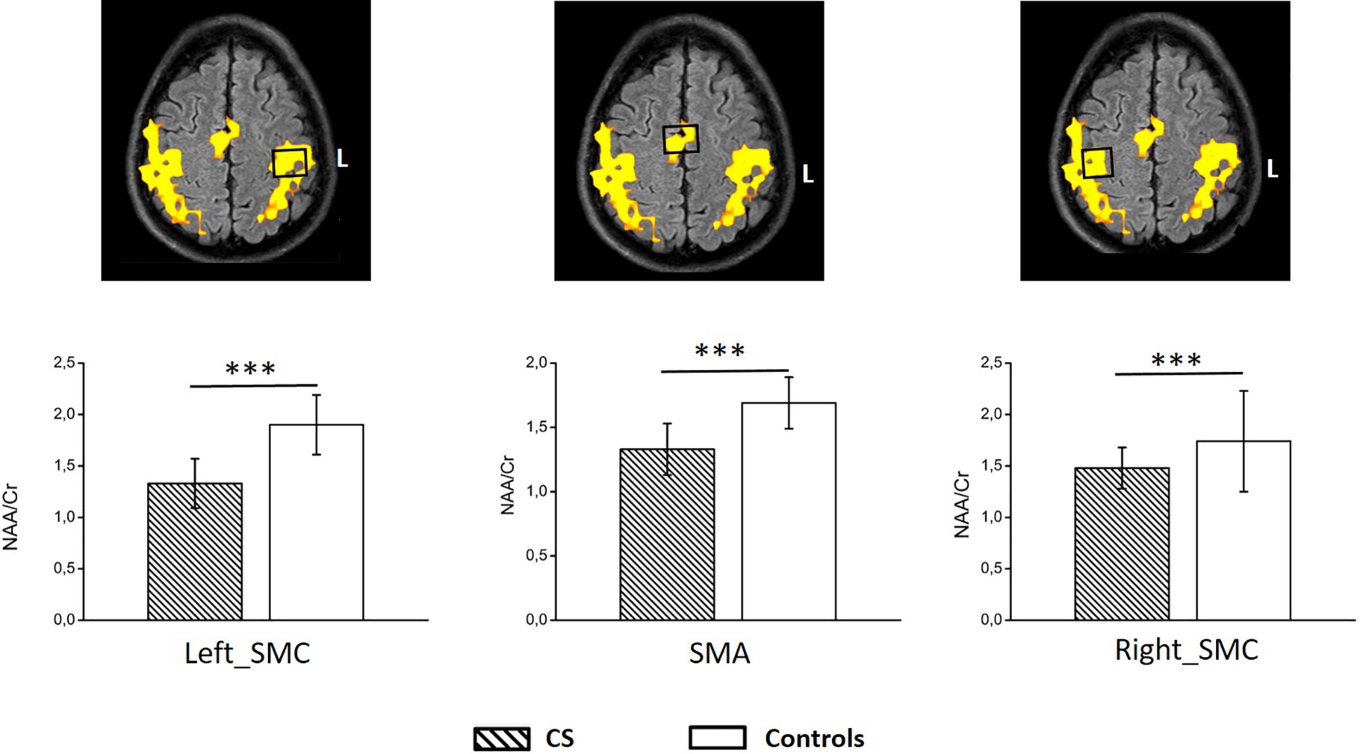 Fig. 4, MR-spectroscopy results of the motor cortex of cervical spondylosis patients (CS, n =32) and healthy controls (HC, n =32). The volume of interest was located on the activated area in both the primary sensorimotor cortex (SMC) and supplementary motor area (SMA) after a bilateral finger-tapping fMRI task paradigm (see upper image as example of voxel location for measurements). Graphs represent the NAA/ Cr (mean ± SD) values obtained after quantification in each group. A significant reduction was observed in all areas compared to controls suggesting significant neuronal/axonal damage. *** represents P < .001 after unpaired t -test. NAA , N-acetylaspartate; Cr , creatine.