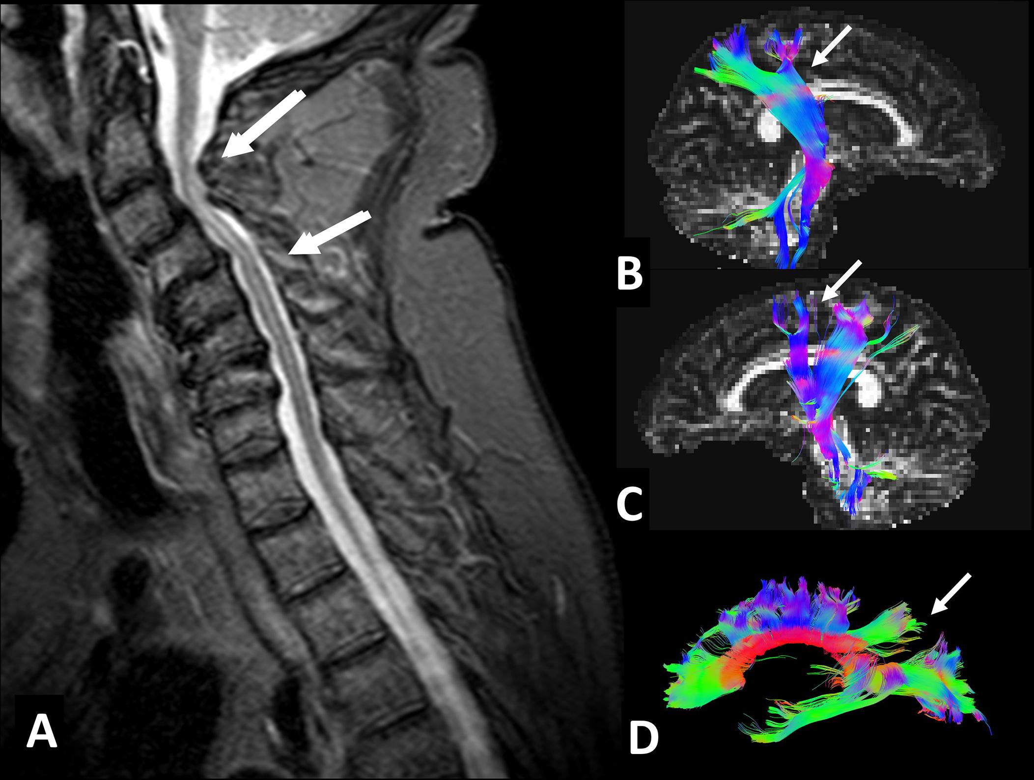 Fig. 5, Tractography results obtained in a patient with cervical spondylosis myelopathy. (A) Sagittal STIR of a 69-year-old male with cervical spondylosis and myelopathy at C2-C5 levels, significant cervical lordosis loss, and several diffuse herniated discs from C2 to C7. Clinically the patient only presented bilateral manual clumsiness. No cervicalgia or cervicobrachialgia was present. (B, C, D) Tractography results suggested significant bilateral and symmetrical axonal damage affecting both corticospinal tracts at the distal-anterior regions (B, C) and the corpus callosum (A) at the superior and posterior parietal projection fibers of both hemispheres (see arrows) . Commissural fibers were preserved.