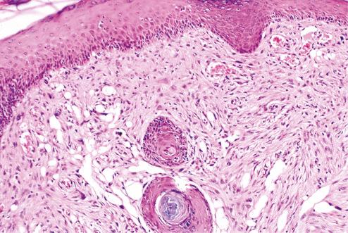 Fig. 12.3, Atypical fibroxanthoma abutting epidermis. Dilated capillaries are commonly seen adjacent to and in the tumor.