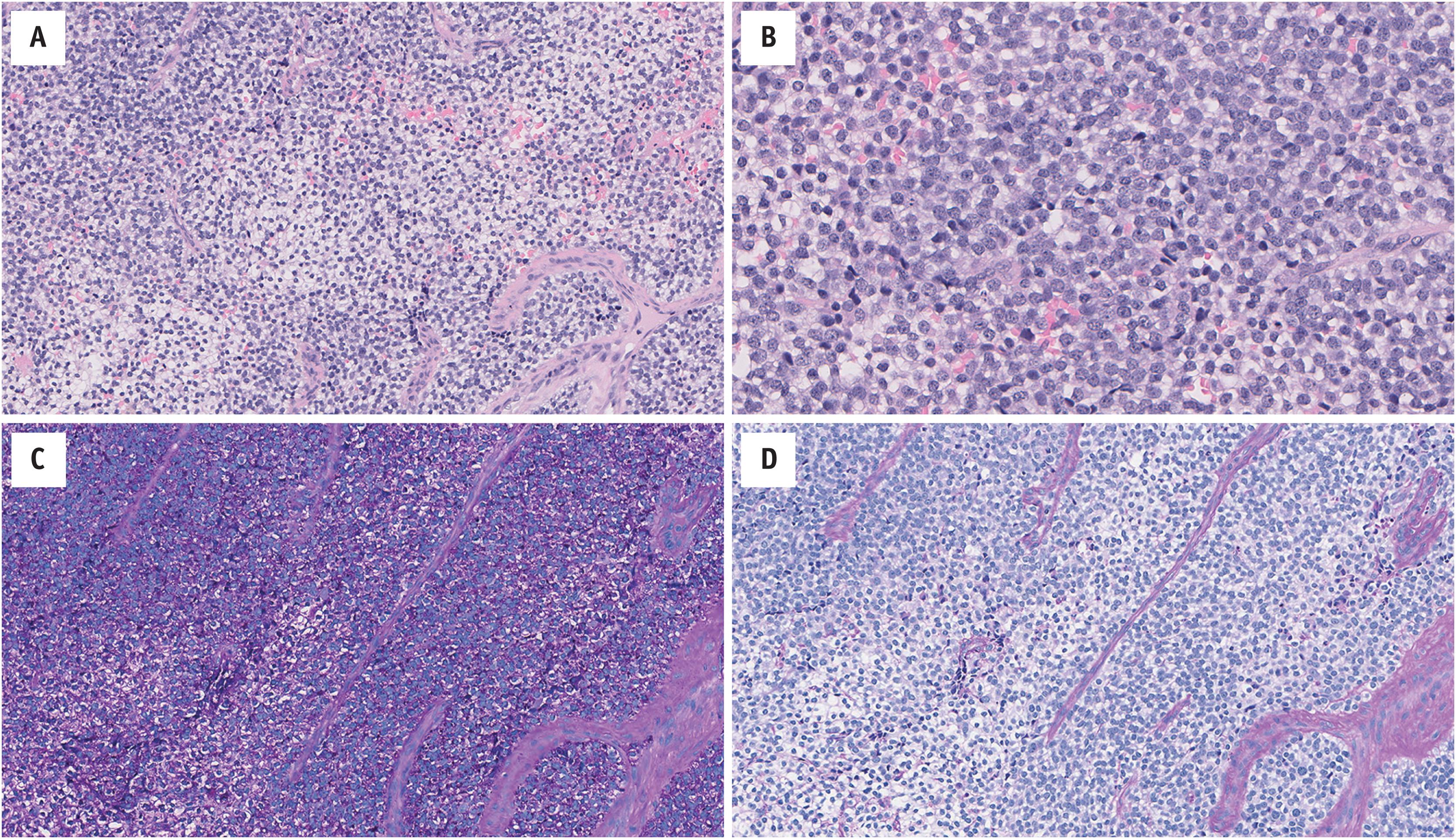 Fig. 14.2, Ewing Family Tumor showing a conventional morphology ( EWSR1-FLI1 fusion gene identified by RNA-seq). (A) Sheets of small round cells with clear to pale eosinophilic cytoplasm with a vague lobular pattern. The nuclei are round and monomorphic. The tumor is supported by a delicate thin-walled vasculature. (B) The cytoplasm is scant with indistinct cell borders. The nuclei have delicately speckled chromatin and small nucleoli. The presence of intracytoplasmic glycogen is highlighted using the periodic acid-Schiff stain: (C) with, and (D) without diastase.