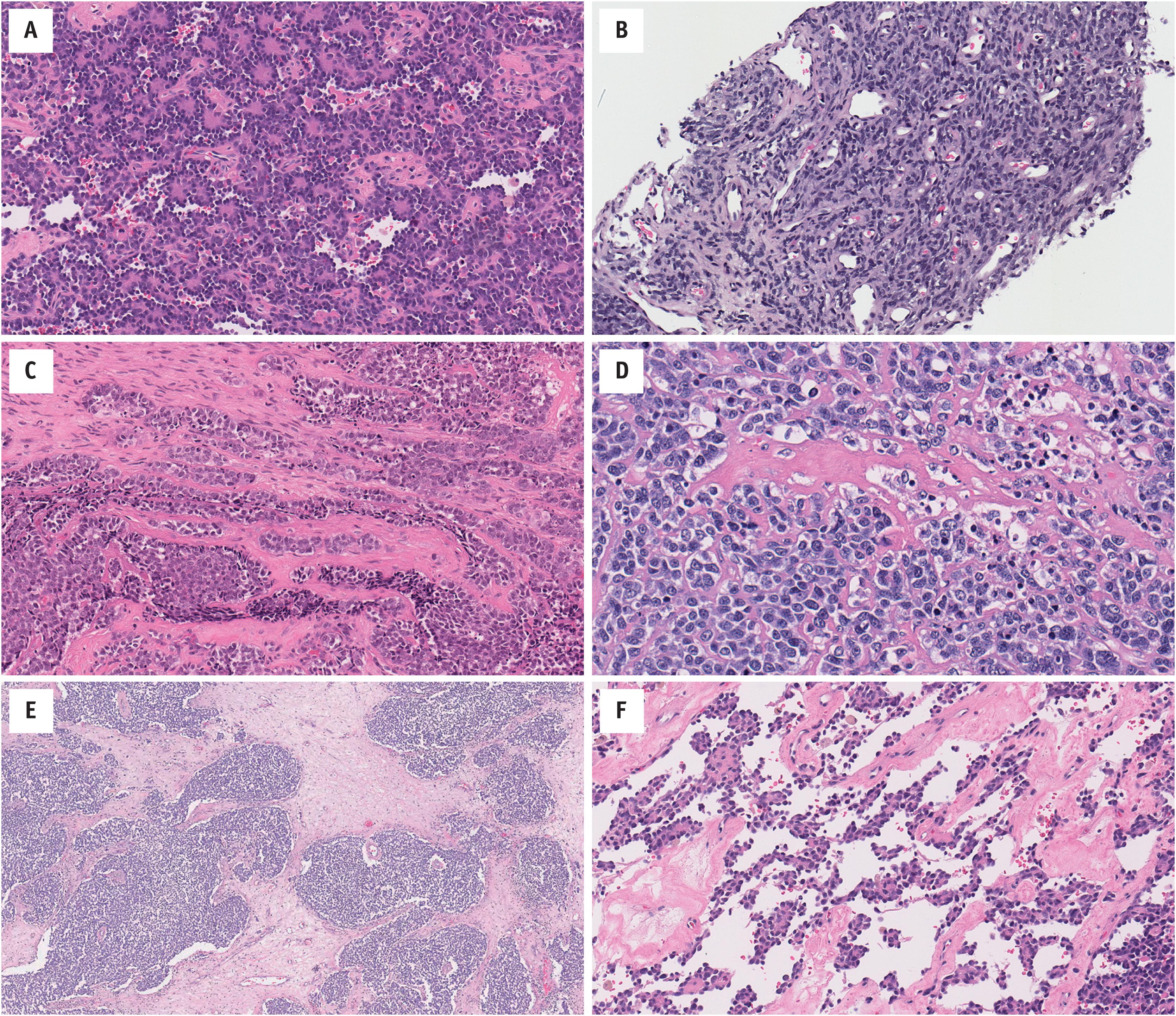 Fig. 14.3, Ewing Family Tumors occasionally contain other morphologies. (A) Rosette and pseudorosettes (peripheral neuroectodermal tumor; EWSR1-FLI1 fusion gene); (B) large cells (atypical Ewing sarcoma; EWSR1-ERG fusion gene); and (C) epithelial differentiation (adamantinoma-like; EWSR1-FLI1 fusion gene [for full details, see Weinreb et al. 2008]). Very rarely they may have: (D) osteoid-like matrix mimicking small cell osteosarcoma ( EWSR1-FLI1 fusion gene); (E) desmoplastic stroma mimicking desmoplastic small round cell tumor ( EWSR1-FLI1 fusion gene); and (F) pseudovascular channels mimicking angiosarcoma ( EWSR1-FLI1 fusion gene), amongst other findings.