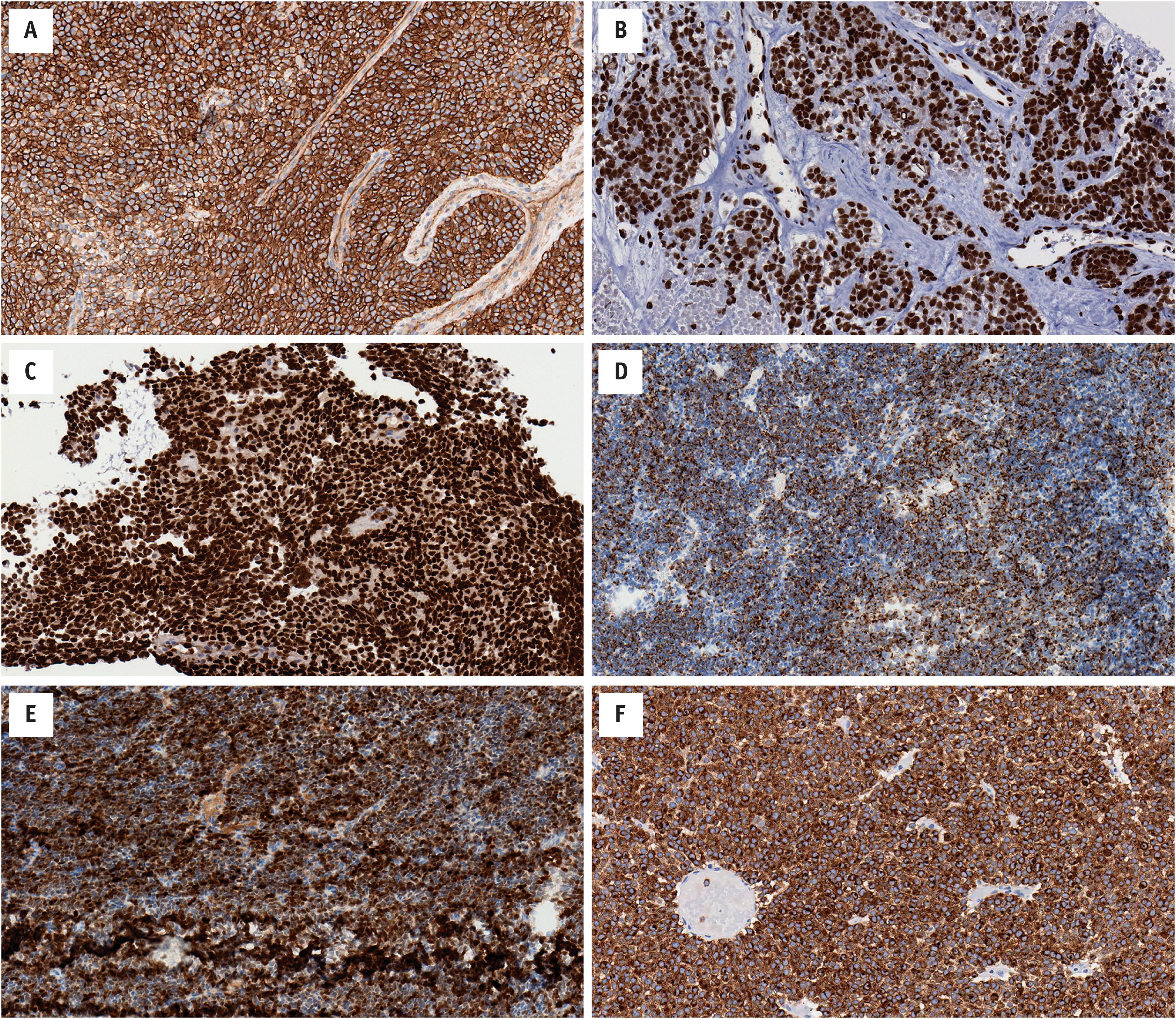 Fig. 14.4, The role of immunohistochemistry is typically limited, and non-specific, in Ewing Family Tumors. (A) These neoplasms typically express CD99 with a membranous pattern (same case as 17-2). (B) Tumors with FLI1 fusion partners express FLI1 ( EWSR1-FLI1 fusion gene). (C) Tumors with ERG fusion partners express ERG ( FUS-ERG fusion gene). Occasionally tumors may contain diffuse expression of other markers, such as (D) keratin ( EWSR1-FLI1 fusion gene), ( E ) S100 (same case as “D”), and (F) synaptophysin ( EWSR1-FEV fusion gene).
