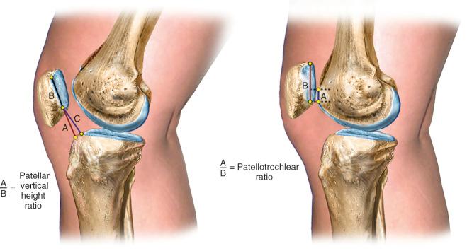 FIG 37-1, Left, Method used to determine patellar vertical height ratio on lateral radiograph with a quadriceps contraction to show the maximum elevated position of the patella. The numerator, line segment A , is the distance between the most ventral (anterosuperior) rim of the tibial plateau and the lowest end of the patellar articular surface. The denominator, line segment B , is the maximum length of the patellar articular surface. An alternative numerator, line segment C , locates the tibial reference point on the middle of the tibial plateau. The patellar vertical-height ratio equals A/B or C/B. Right, Alternative patellotrochlear ratio measurement. The mean ratio is 32 ± 12%; >50% indicates patella infera; <12% indicates patella alta.