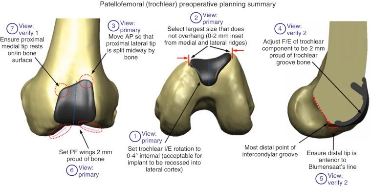 FIG 37-2, The preoperative planning steps for the precise location of the trochlear implant. AP , Anteroposterior; F/E , finite-element; I/E , internal/external; PF , patellofemoral.