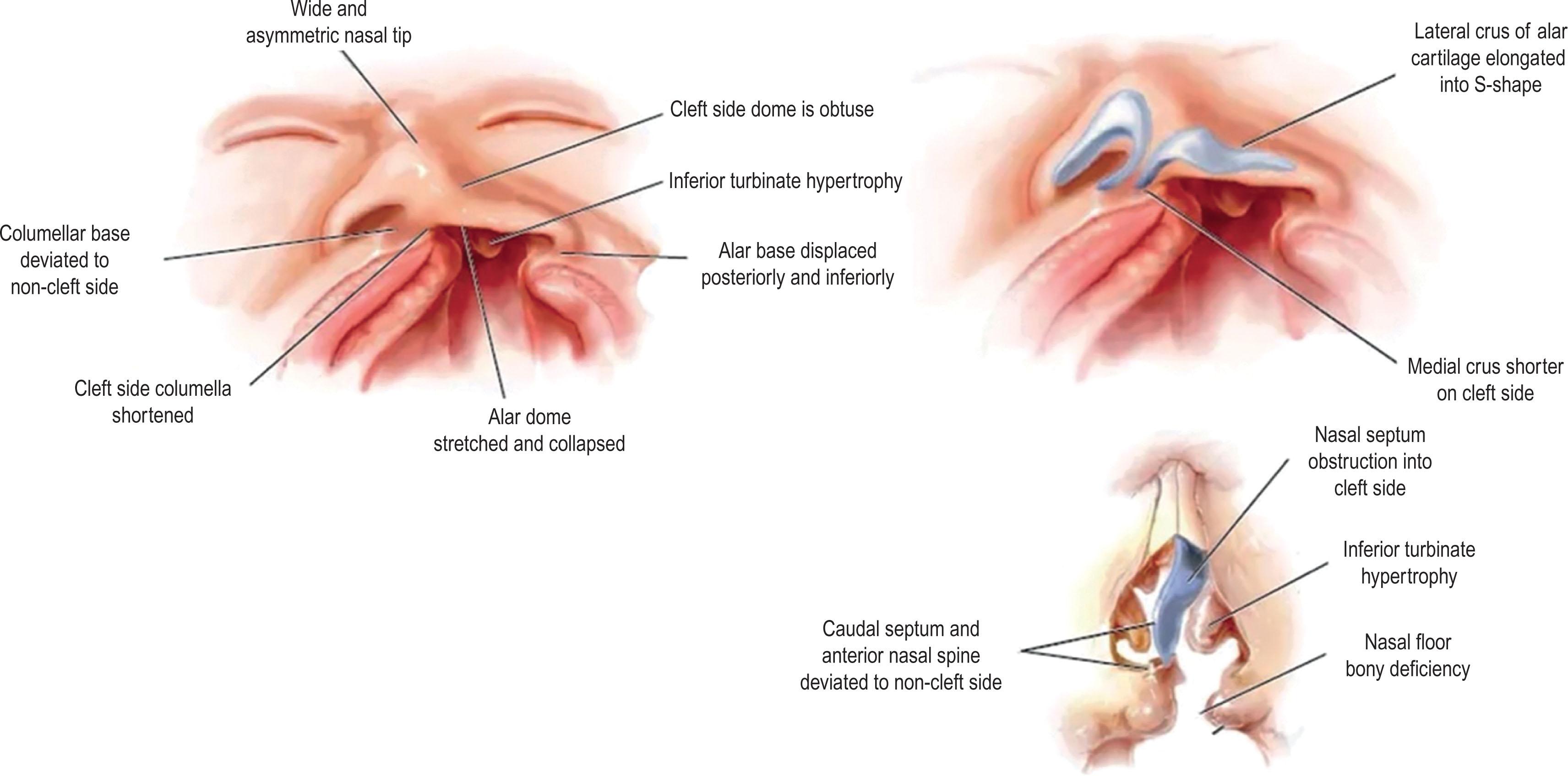 Figure 19.1.1, Typical anatomic aberrations of the unilateral cleft lip and nose deformity.