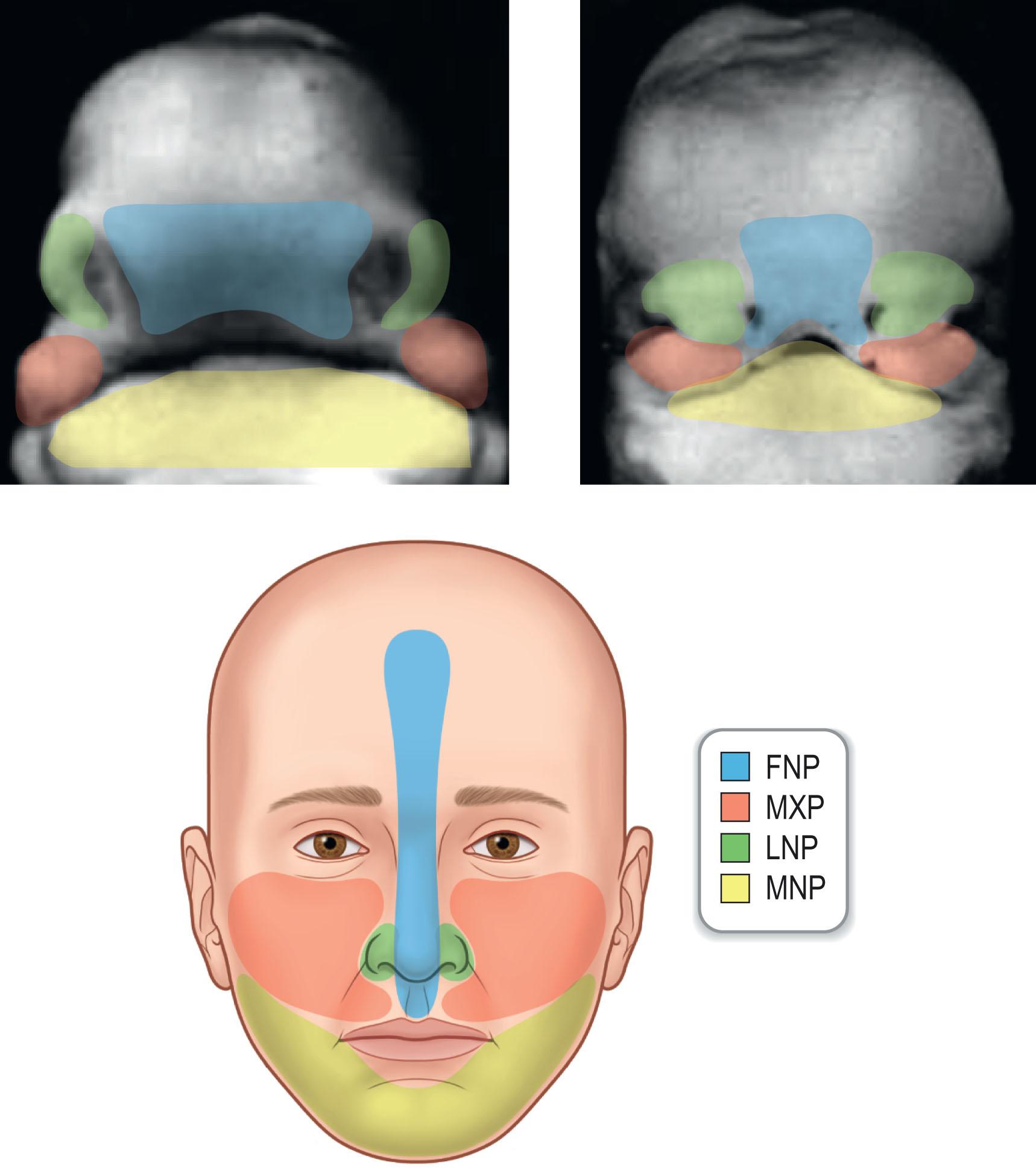 Figure 19.1.2, Prominences of the face: frontonasal prominence (FNP), maxillary prominence (MXP), lateral nasal prominence (LNP), and mandibular prominence (MNP).