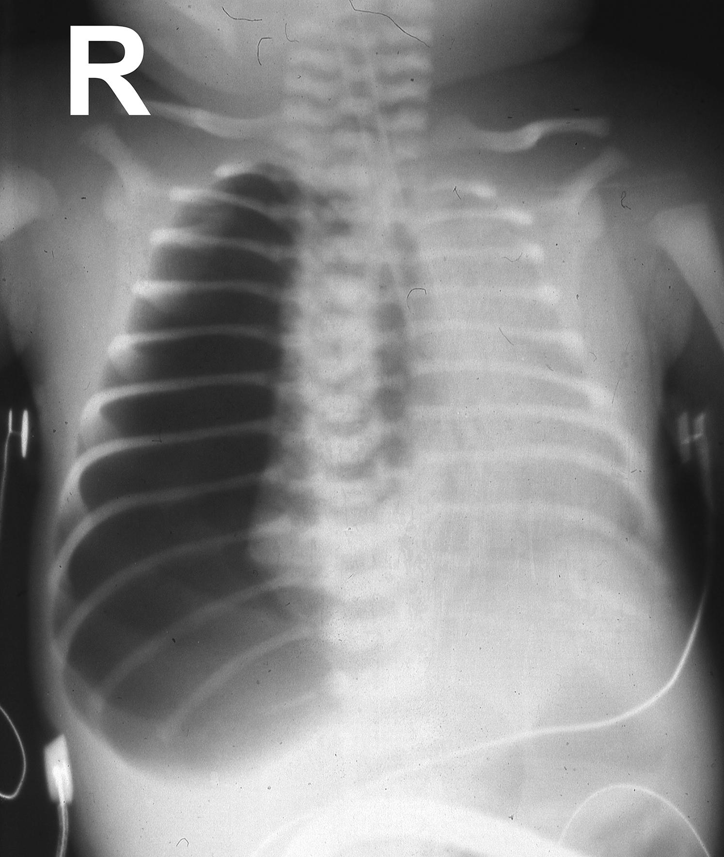 Fig. 9.1, Tension pneumothorax—chest x-ray of 6-week-old boy involved in a road traffic accident. Shows mediastinal displacement and lung fields without markings.