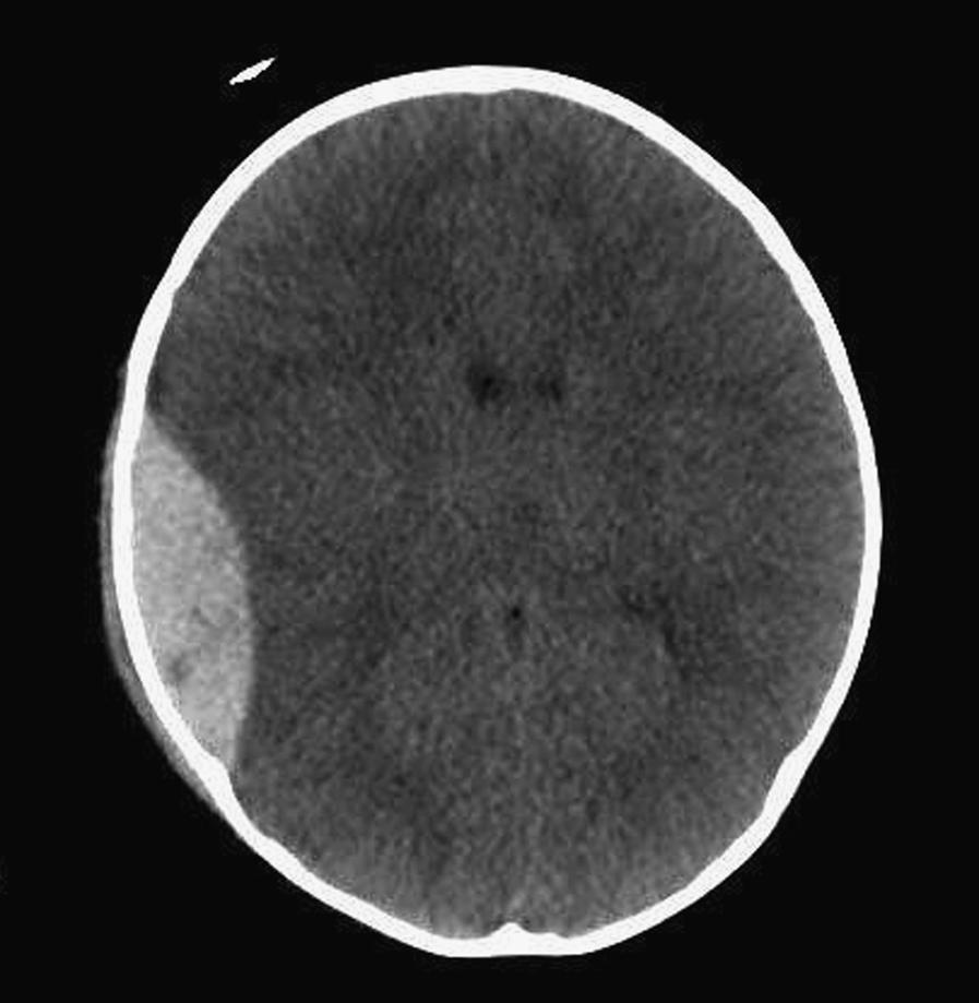 Fig. 9.2, CT scan of a 14-year-old-boy following head trauma showing the convex-shaped lesion in the extradural space