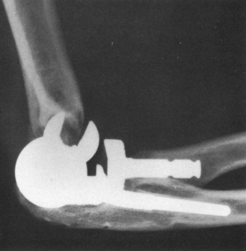 FIG 89.1, Five-and-a-half years after insertion of an unstemmed humeral component, a fracture has occurred across the distal humeral condyles at the site of fixation of a 39-year-old patient with rheumatoid arthritis.