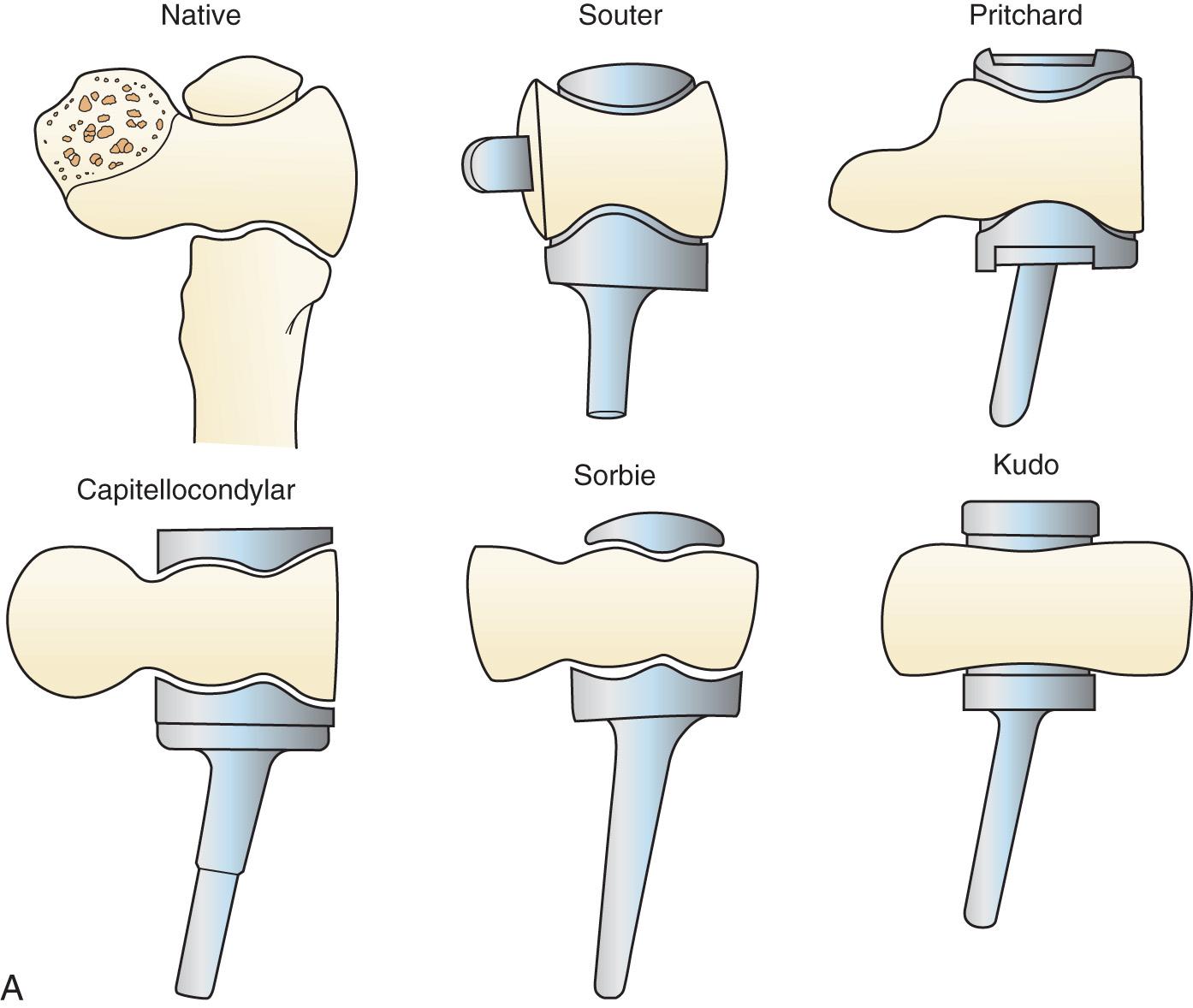 FIG 89.2, (A) The intrinsic constraint of the ulnohumeral joints of five different unlinked total elbow arthroplasties were compared to that of the native elbow joint in an in vitro biomechanical study. (B) The torque (bar graphs) and angular displacement (line graphs) of the Souter and Kudo implants were most similar to the human elbow.