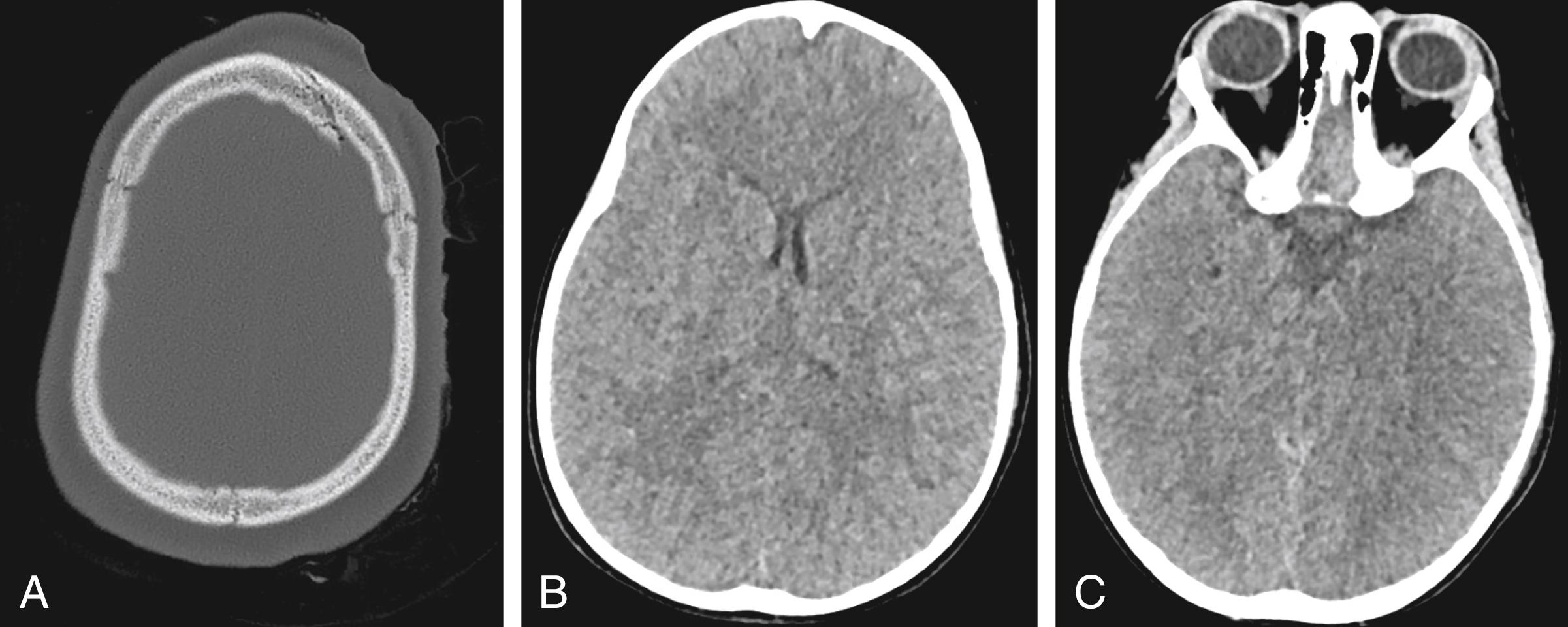Figure 4.1, Axial head CT without contrast demonstrates a minimally displaced left frontal fracture (A) without evidence of large intracranial hemorrhage (B, C).