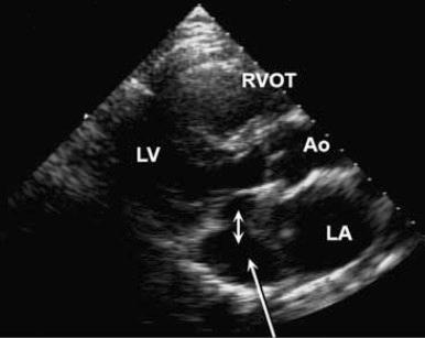 Figure 33-1, Transthoracic echocardiogram showing a dilated coronary sinus (long arrow) and small communication between the coronary sinus and left atrium (small double-headed arrow) . Key: Ao, Aorta; LA, left atrium; LV, left ventricle; RVOT, right ventricular outflow tract.