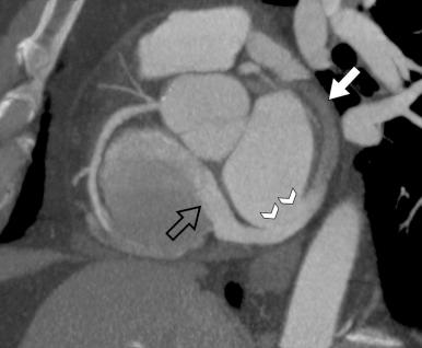 Figure 33-2, Contrast-enhanced gated multidetector computed tomography image of a 53-year-old man with unroofed coronary sinus. Multiplanar reformat image in valve plane shows coronary sinus partially unopacified (white arrow) , site of unroofing and communication with the left atrium (arrowheads) , and jet of dense contrast entering the right atrium through the Thebesian valve (open arrow) .