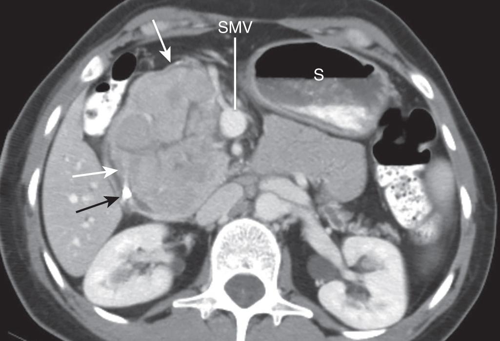 FIGURE 99.1, Axial image of a contrast-enhanced computed tomography scan from a patient with a large acinar cell carcinoma demonstrating local compression of the duodenum (white arrows) causing gastric distention (S) and biliary obstruction that required endobiliary stenting (black arrow) . SMV , Superior mesenteric vein.