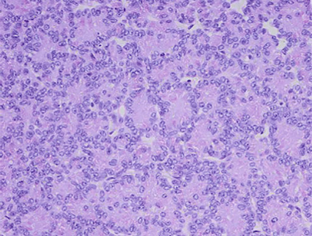 FIGURE 99.2, Histologic appearance of acinar cell carcinoma with periodic acid–Schiff positivity. Note the solid, trabecular, and glandular growth pattern. Nuclei are round to oval with minimal pleomorphism and a single prominent nucleoli.