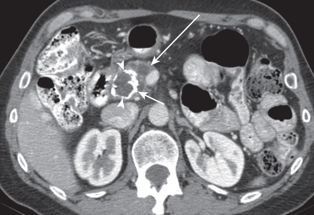 FIGURE 99.3, Axial image of a contrast-enhanced computed tomography scan from a patient with a solid pseudopapillary tumor of the pancreas with solid and cystic characteristics (long arrow) and central calcification ( short arrow and arrowheads ).