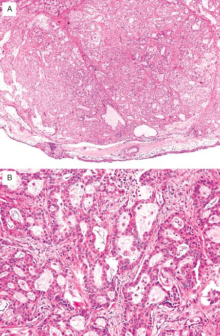 FIG. 28.1, Mucoepidermoid carcinoma. (A) This tumor forms a subepithelial mass in this bronchus. (B) Tumor cells form glands with microcystic spaces that are lined by cuboidal or columnar cells, and smaller numbers of squamoid cells are seen.