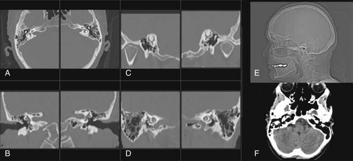Fig. 8.1, Routine Picture archiving and communication system (PACS) temporal bone hanging protocol: (A) Axial right and left thin-section (submillimeter) bone algorithm acquisition images, (B) right and left coronal thin-section bone algorithm reconstructions, (C) right and left thin-section short-axis (similar to Pöschl projection) reconstructions, (D) right and left thin-section long axis (similar to Stenver projection), (E) scout image, and (F) axial standard algorithm large field of view thicker section (2–3 mm).