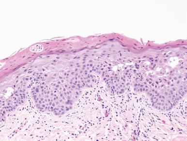 Figure 4.12, Moderate Dysplasia.