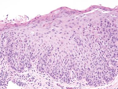 Figure 4.13, Severe Dysplasia.