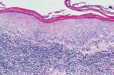 Figure 4.14, Lichenoid Dysplasia.