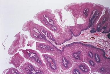 Figure 4.15, Squamous Papilloma of the Oral Cavity.