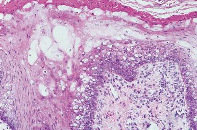 Figure 4.18, Hairy Leukoplakia.