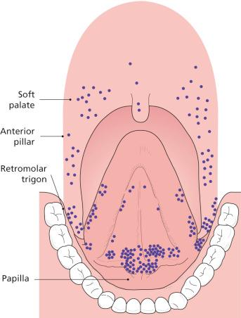 Figure 4.19, Scattergram indicating site of origin of over 200 asymptomatic early squamous cell carcinomas. Note concentration of lesions around papilla at exit of Wharton duct, ventrolateral aspect of tongue, lingual aspect of retromolar trigone, anterior pillar, and soft palate.