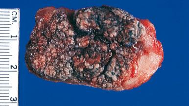 Figure 4.20, Gross Appearance of Verrucous Carcinoma With Extensive Involvement of the Tongue.